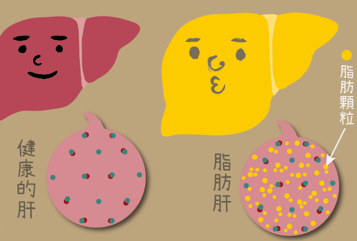 脂肪肝的形成原因 脂肪肝的形成原因