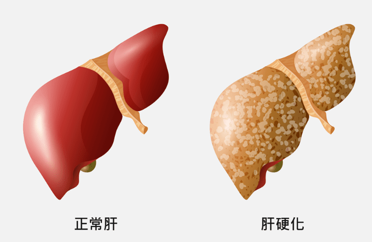 肝硬化症狀 肝硬化症狀