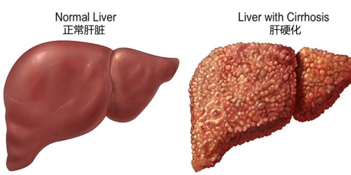 肝硬化中期症狀