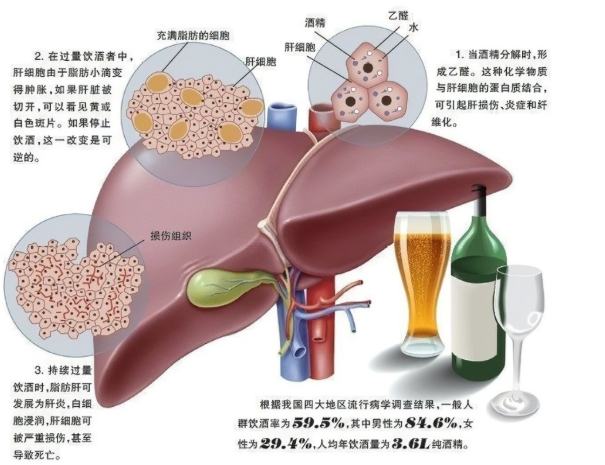 酒精性肝硬化定義