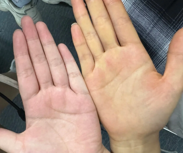 手掌黃是什麼原因