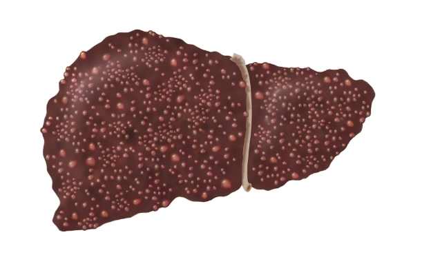 肝硬化申請殘障手冊 肝硬化申請殘障手冊