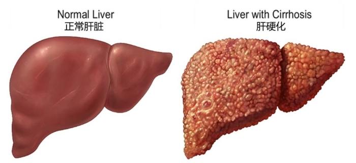 肝硬化治療