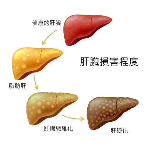 肝硬化皮膚症狀