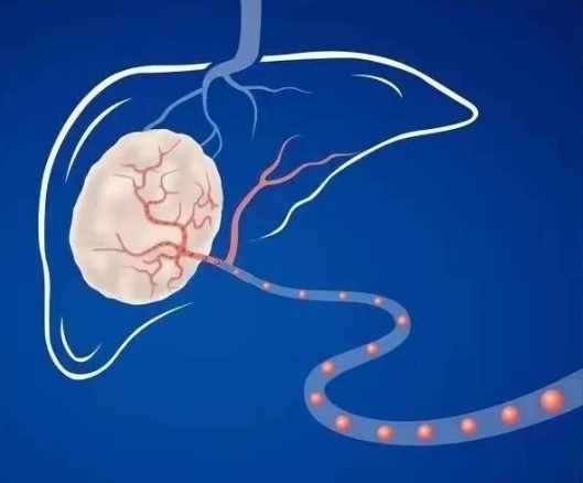 肝動脈栓塞 肝動脈栓塞