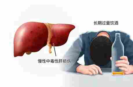 肝硬化戒酒恢復