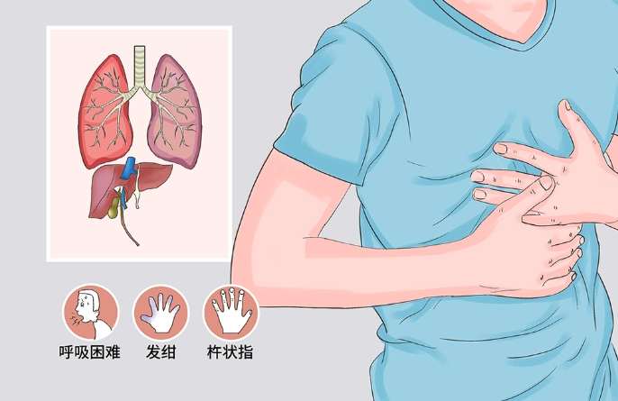 肝肺綜合症症狀