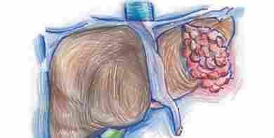 肝血管瘤原因 肝血管瘤原因
