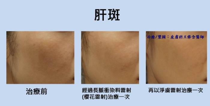 肝斑治療 肝斑治療