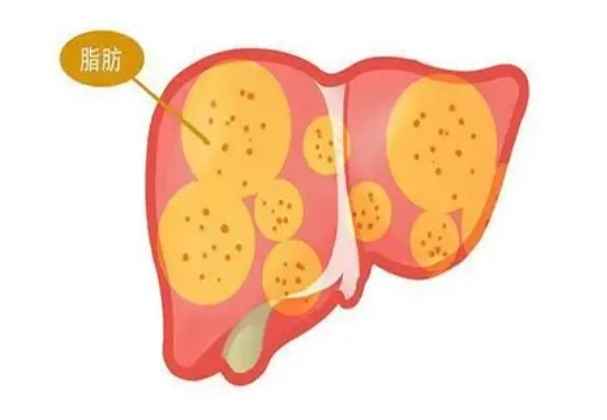 輕度脂肪肝症狀