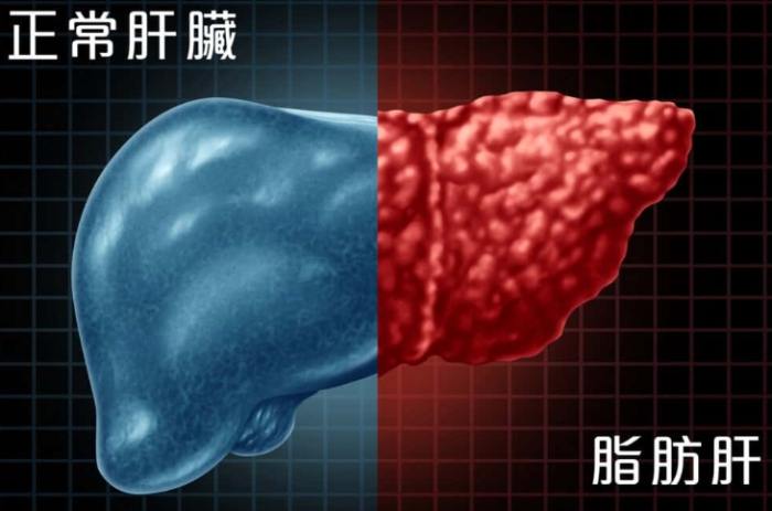 中醫治療脂肪肝