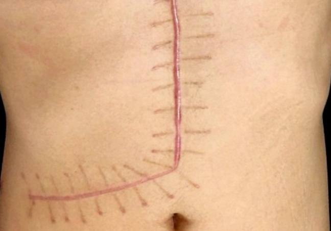 肝臟捐贈疤痕護理