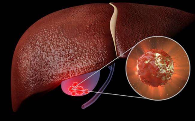肝胆排毒自然療法