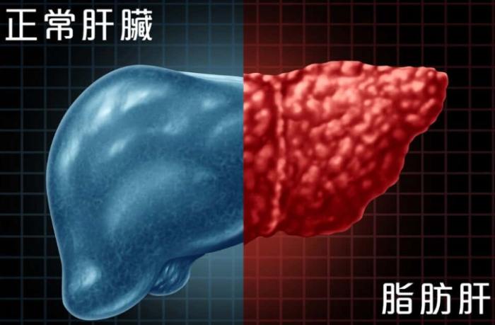 脂肪肝消除方法