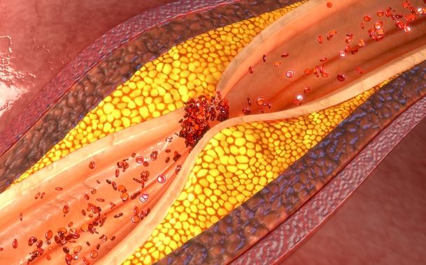 低密度膽固醇 空腹