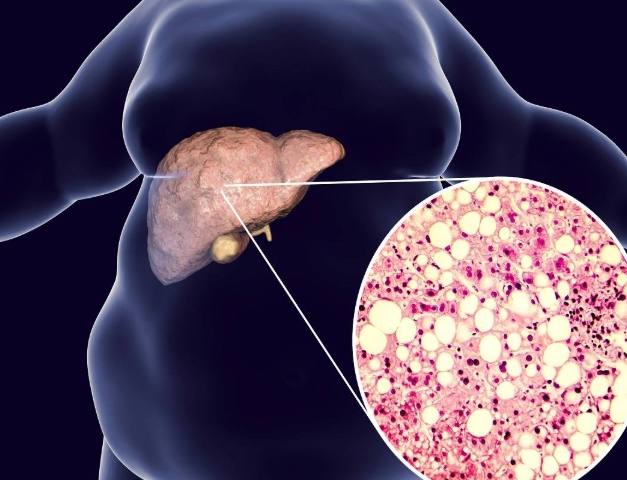 脂肪肝指數 正常值 脂肪肝指數 正常值
