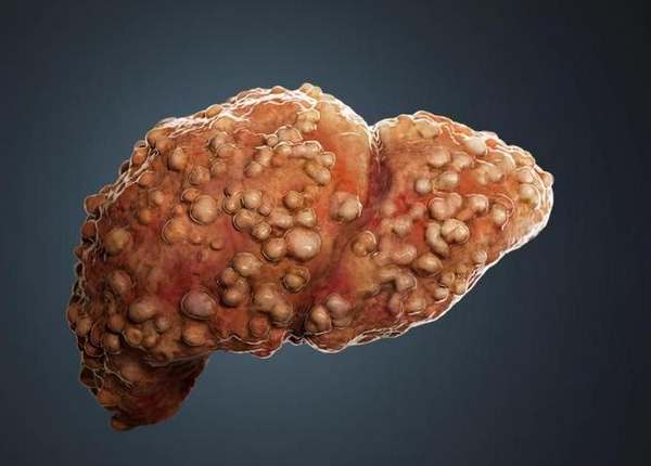 肝硬化醛固酮治療