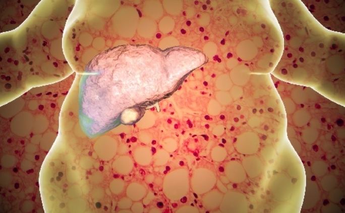 脂肪肝飲食禁忌