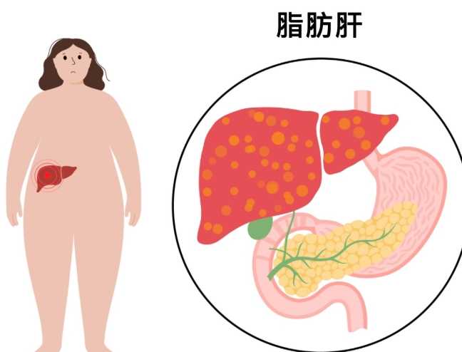 脂肪肝嚴重程度