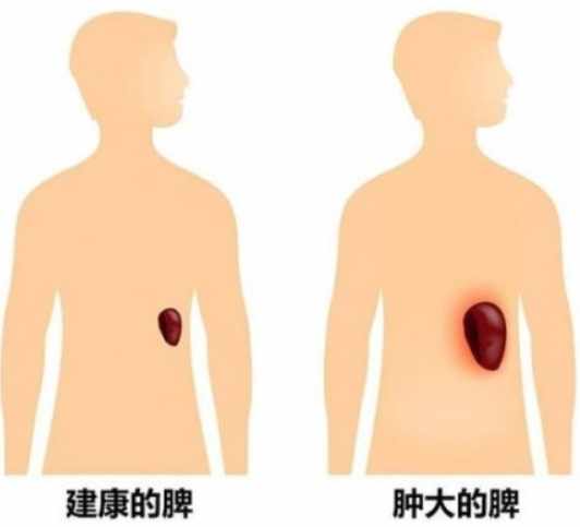 脾臟腫大原因