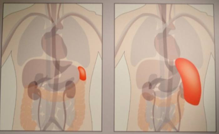 脾腫大症狀