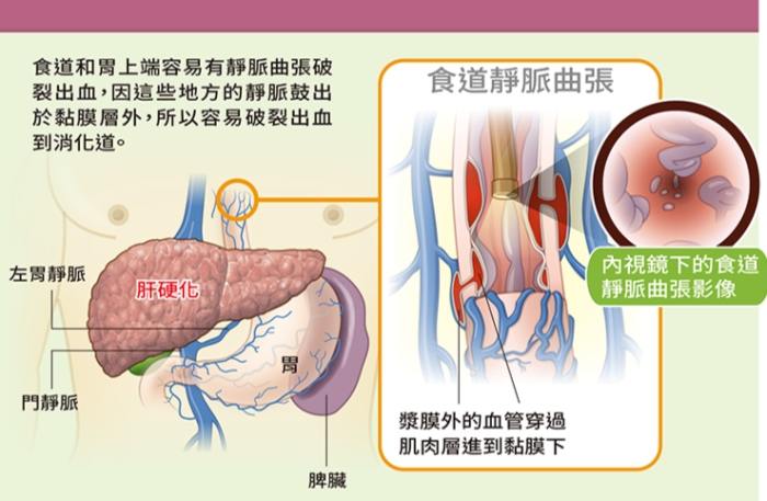 肝硬化末期有救嗎