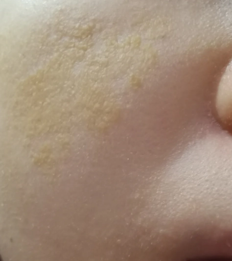 皮膚突然黃一塊原因 皮膚突然黃一塊原因