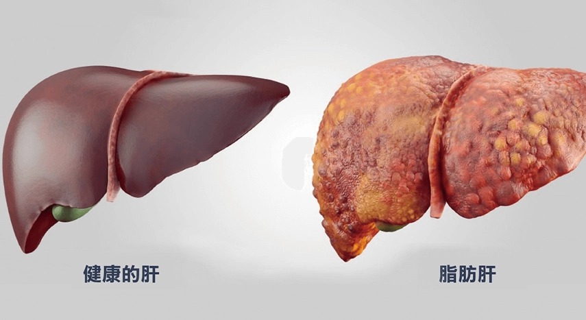 脂肪肝肝硬化症狀