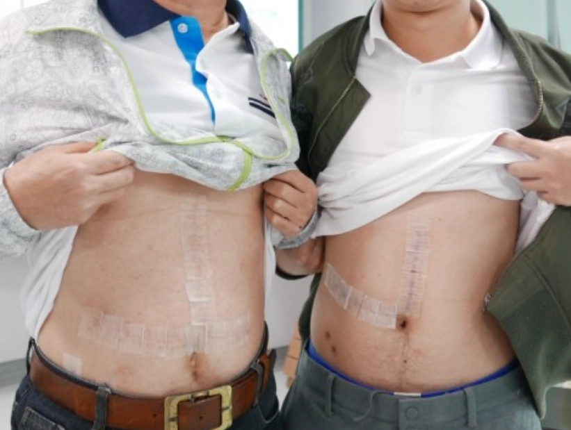 肝臟捐贈體重限制 肝臟捐贈體重限制