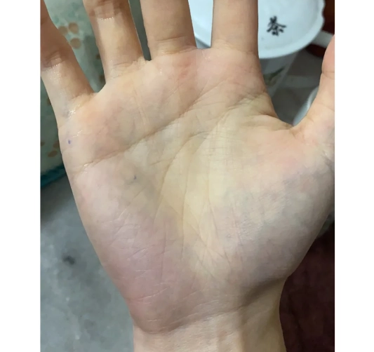 手掌發紫原因 手掌發紫原因