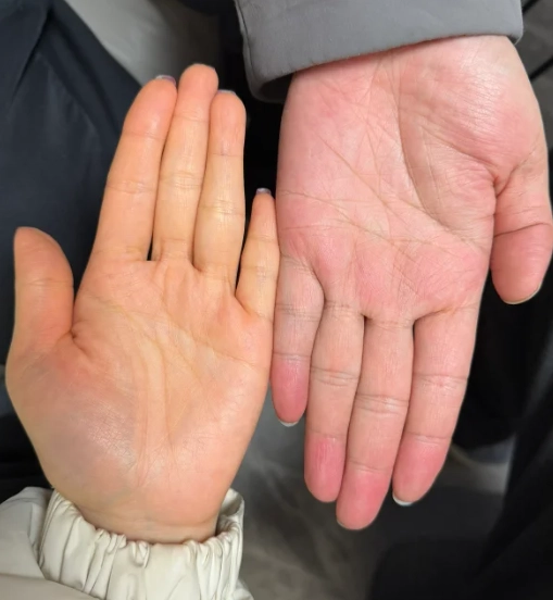 手掌變黃健康問題