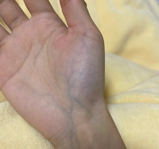 手掌血管明顯