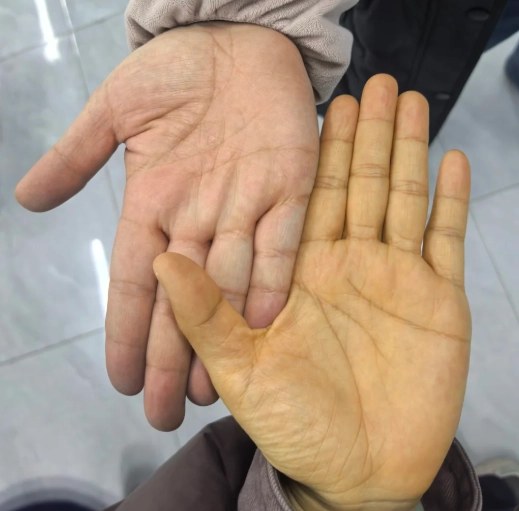 手掌發黃 中醫
