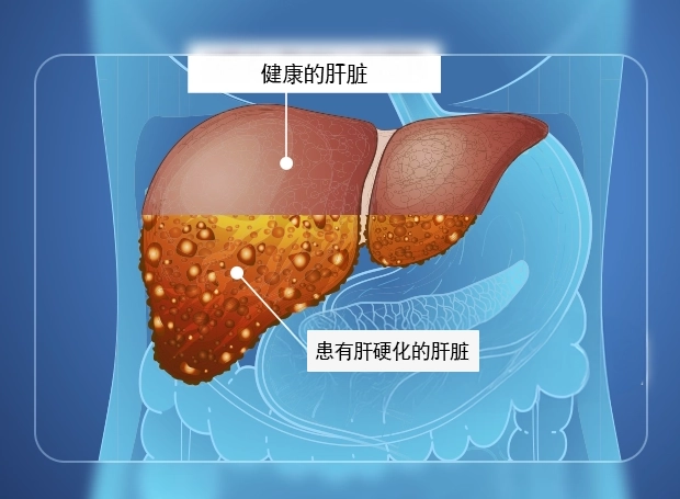 肝硬化末期症狀 肝硬化末期症狀