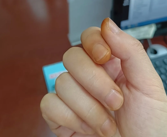 手指發黃原因 手指發黃原因