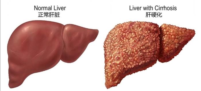 為什麼會肝硬化