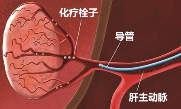 肝栓塞治療費用