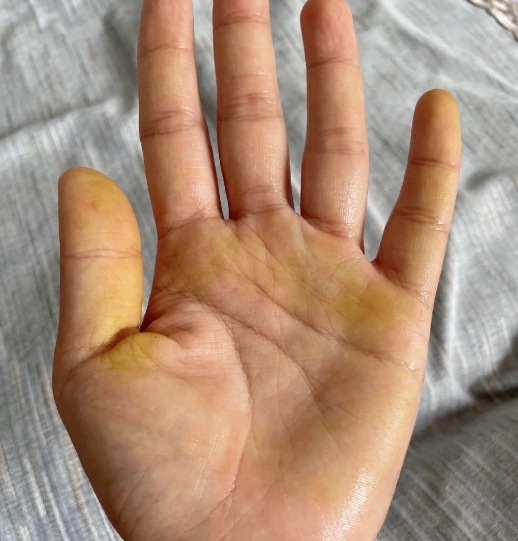 手指變黃