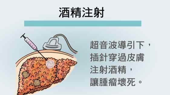 肝腫瘤手術復原時間