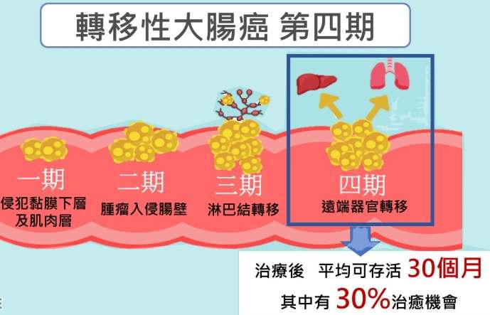 大腸癌肝轉移症狀