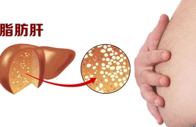 脂肪肝檢查項目