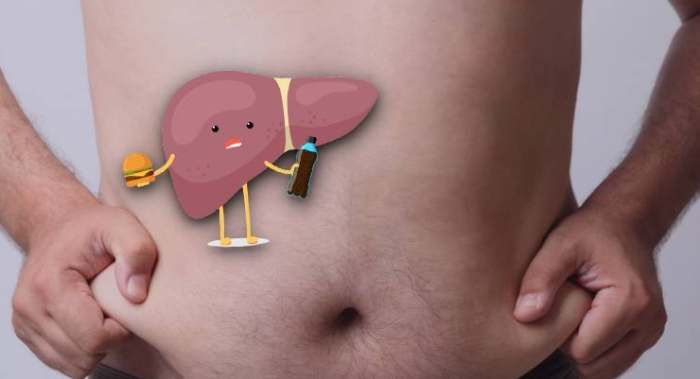 脂肪肝如何治療