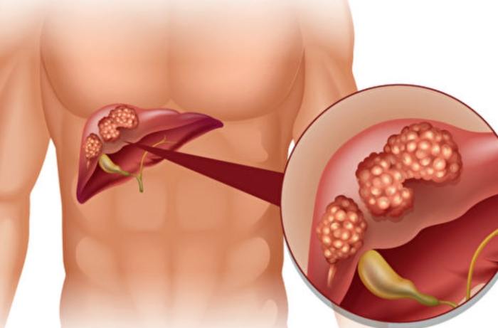肝癌可以喝茶嗎