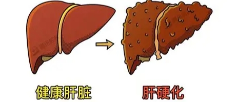 肝硬化第三期存活率