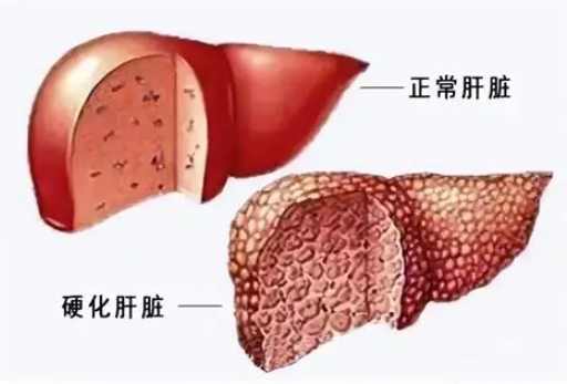 b肝檢查要空腹嗎