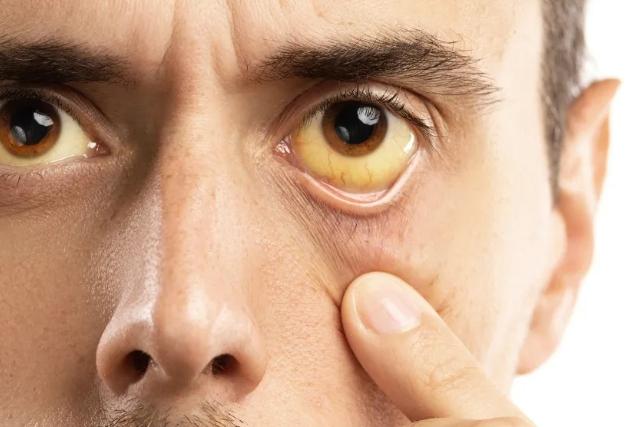 大人黃疸指數降不下來