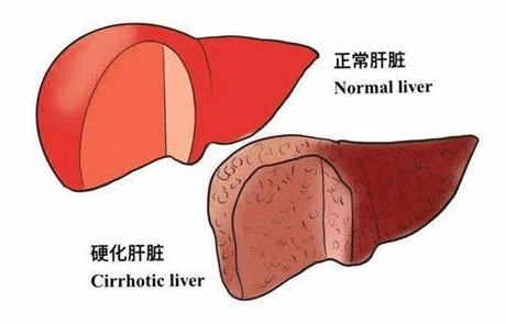 肝硬化前兆 肝硬化前兆