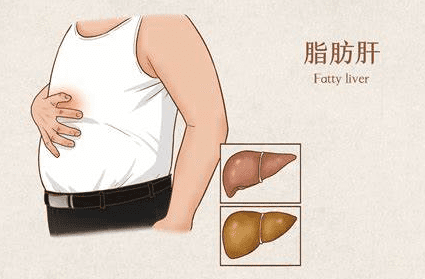 脂肪肝的基本認識 脂肪肝的基本認識