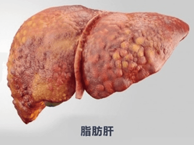 肝硬化診斷 肝硬化診斷