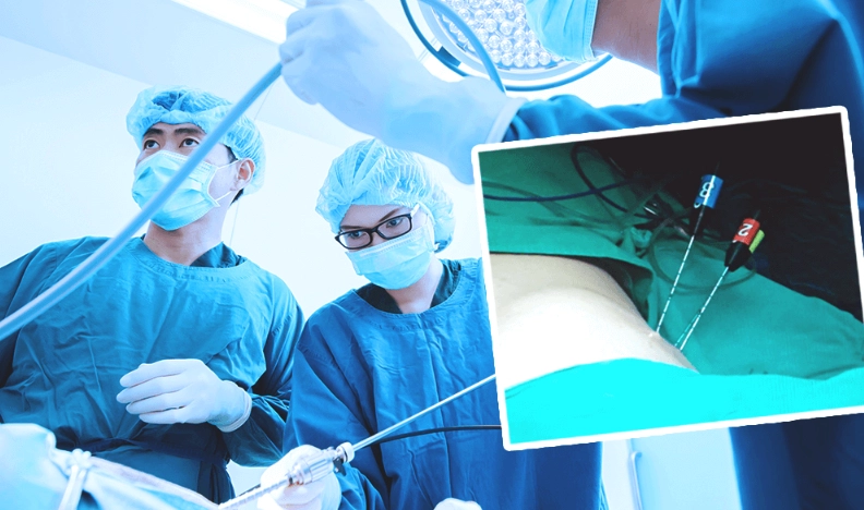 肝癌電燒算手術嗎